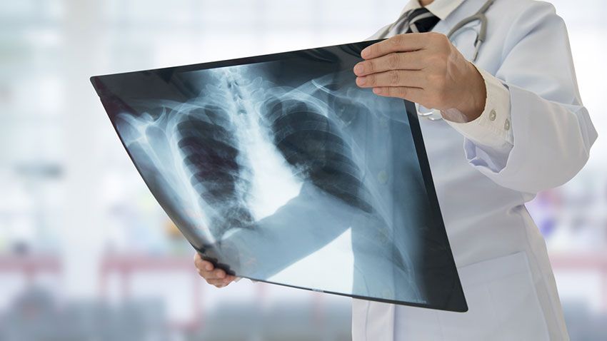 Médecin observant la radiographie pulmonaire