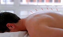 acupuncture