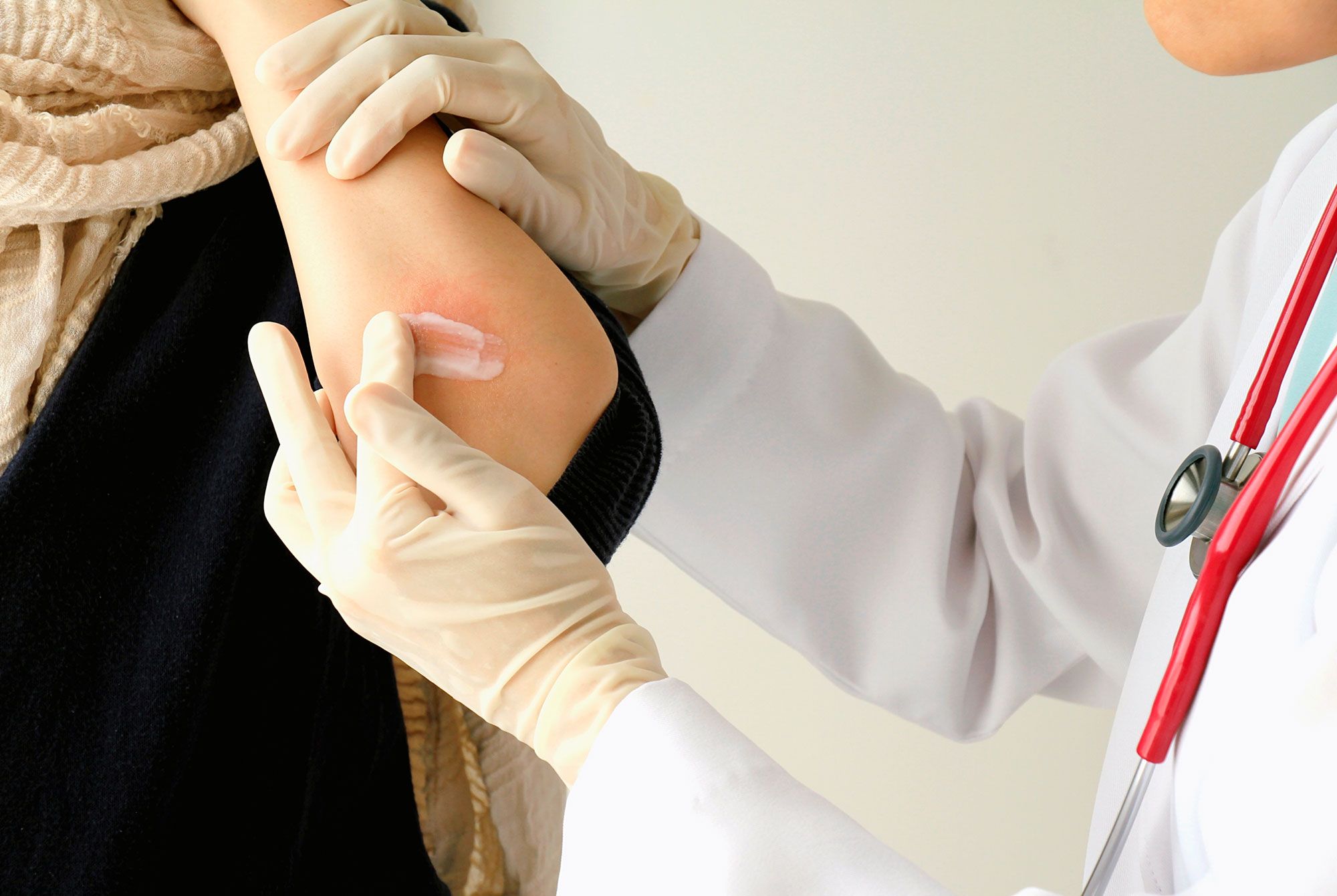 traitement du psoriasis