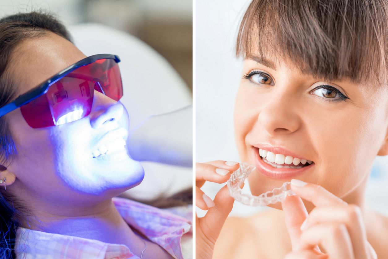 Le blanchiment peut être fait avec des lasers ou des attelles.