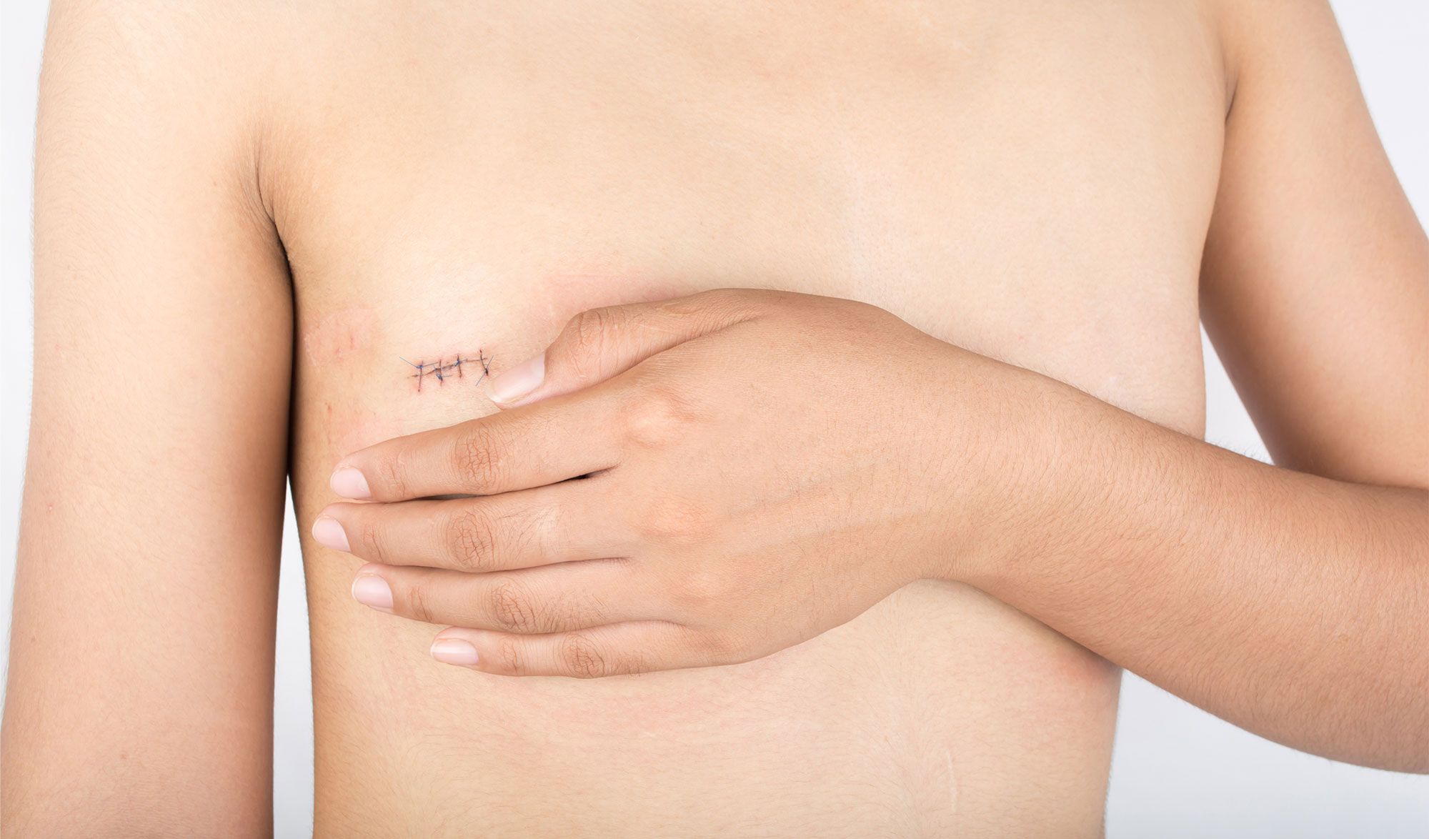 types de mastectomie
