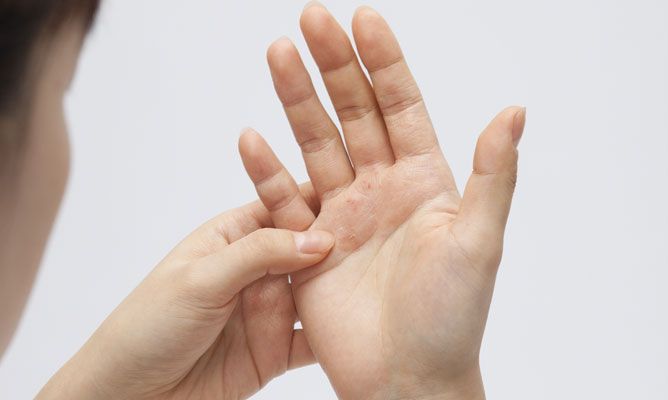 psoriasis